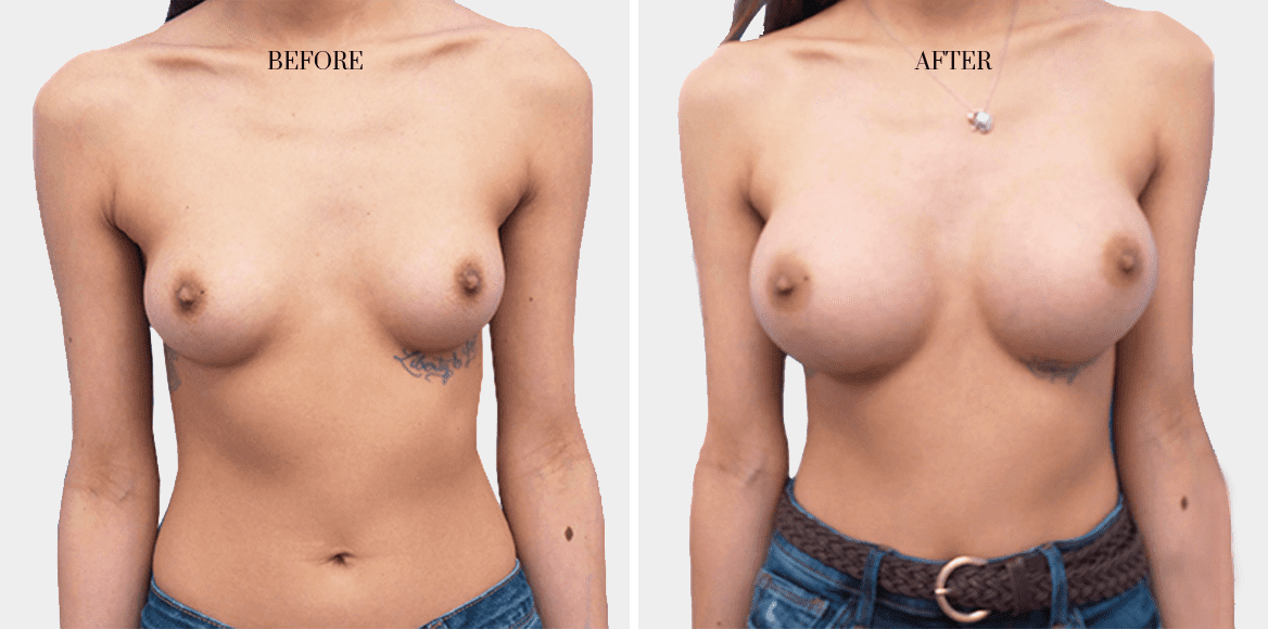 dr-fred-aguilar-breast-enhancement-before-after-2