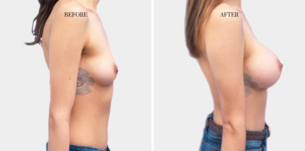 dr-fred-aguilar-breast-enhancement-before-after