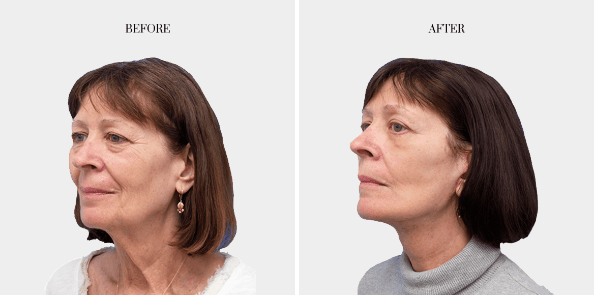 dr-fred-aguilar-facelift-before-after-2