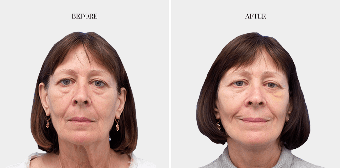 dr-fred-aguilar-facelift-before-after