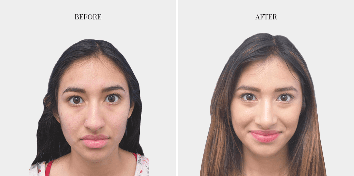dr-fred-aguilar-rhinoplasty-before-after-2