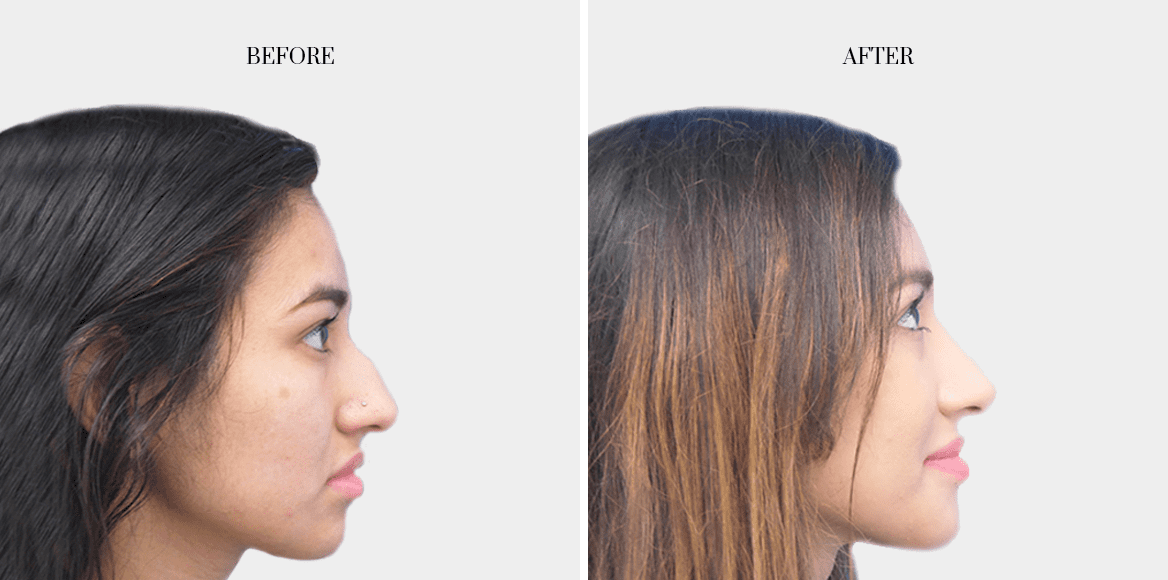 dr-fred-aguilar-rhinoplasty-before-after