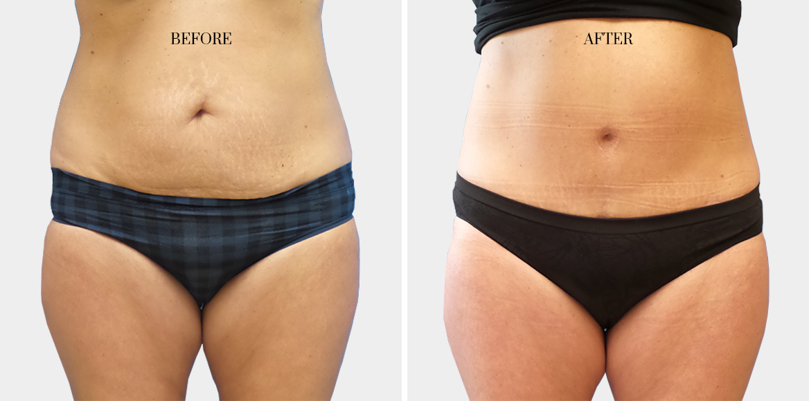 dr-fred-aguilar-facelift-before-after-3