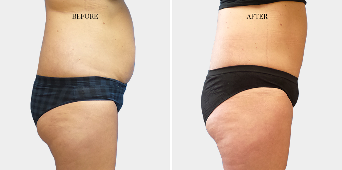 dr-fred-aguilar-facelift-before-after-4